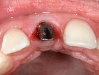 Front tooth implant