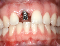 Front tooth implant