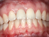 Front tooth implant