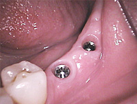 Side cutter implant